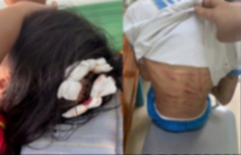 Bé gái bị cha dượng bạo hành ở Hà Tĩnh phải khâu 7 mũi ở đầu Bé gái bị cha dượng bạo hành ở Hà Tĩnh phải khâu 7 mũi ở đầu